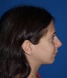 Rhinoplasty