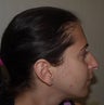 Rhinoplasty