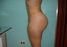 23 year old female treated with Brazilian Butt Lift