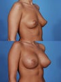 Breast Implants