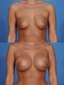 Breast Implants