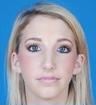 Rhinoplasty