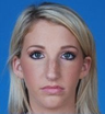 Rhinoplasty