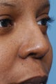 42 Year Old Female Treated For Rhinoplasty Deformity