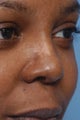 42 Year Old Female Treated For Rhinoplasty Deformity