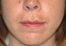 Before and After Lip Lift