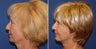 Facelift