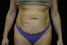 Tummy tuck