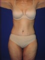 Tummy tuck