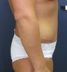 Tummy tuck