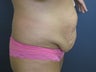 Tummy tuck