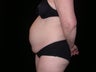Tummy tuck
