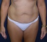 Tummy Tuck