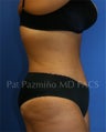 Tummy tuck