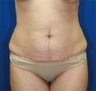 Tummy tuck