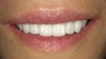 Smile Makeover