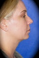 SmartLipo Neck