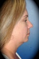 SmartLipo Neck