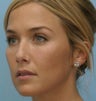 Cheek Dermafiller, Under Eye Dermafiller