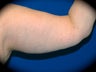 Brachioplasty