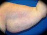 Brachioplasty