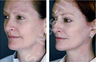 Complete Facial Rejuvenation