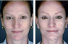 Complete Facial Rejuvenation