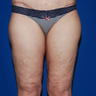 Thigh Lift