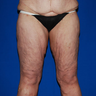 Thigh Lift