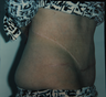 Abdominoplasty and hernia repair after multiple abdominal surgeries