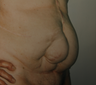 Abdominoplasty and hernia repair after multiple abdominal surgeries