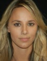Rhinoplasty