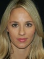 Rhinoplasty
