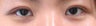 Bilateral Asian Blepharoplasty