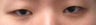 Bilateral Asian Blepharoplasty