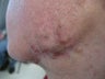 Acne Scars Treatment