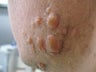 Acne Scars Treatment