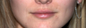 Lip Augmentation