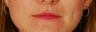 Lip Augmentation