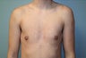 Male patient who underwent breast reduction