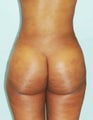 a 29 year old female treated with Brazilian Butt Lift