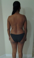 Brazilian Butt Lift