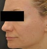 Acne Scarring