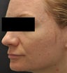 Acne Scarring
