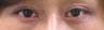 Bilateral Asian Blepharoplasty