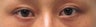 Bilateral Asian Blepharoplasty