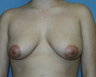 30 year old for breast augmentation. Does not wish to have a lift.