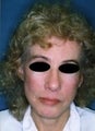 65 year old female patient 