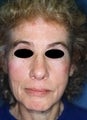 65 year old female patient 