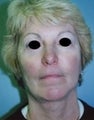 Female patient who underwent facial surgery 